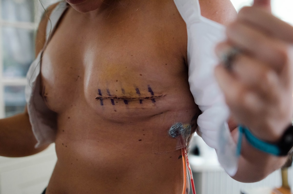 Breast Reduction — illustrative image