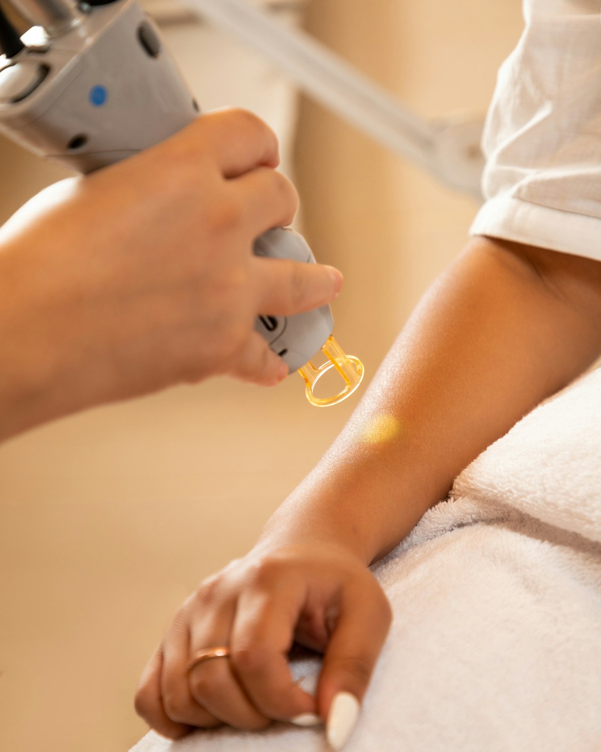 Laser Mole Removal — illustrative image