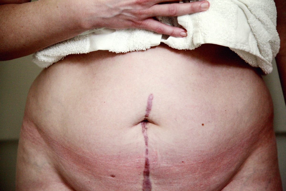 Tummy Tuck — illustrative image